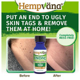 Hempvana End Tag Skin Tag Remover - As Seen on TV
